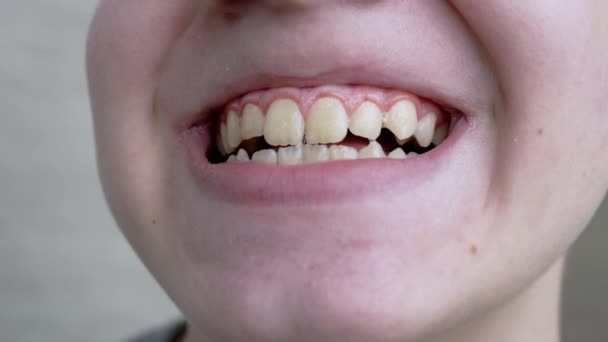 Gülümseyen Dişleri Gösteren Bir Çocuğun Yüzünün Yakın Çekimi. Yavaş çekim — Stok video