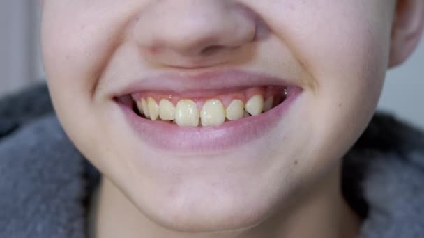 Szeroki uśmiech szczęśliwego dziecka z brudną żółtą powłoką na zębach. Zamknij się. — Wideo stockowe
