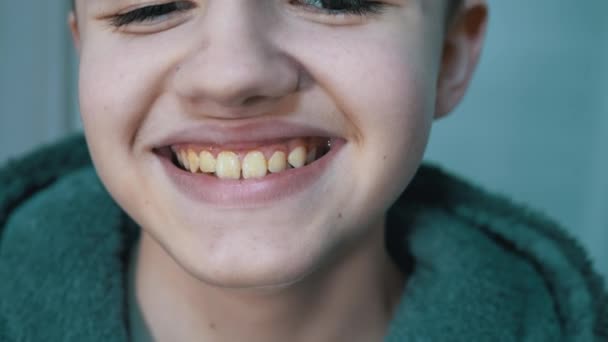 Amplia sonrisa de un niño feliz con un revestimiento amarillo sucio en sus dientes. De cerca. — Vídeo de stock