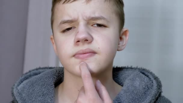 Gefrustreerde tiener raakt, duwen puistjes op zijn gezicht met vinger in de kamer — Stockvideo