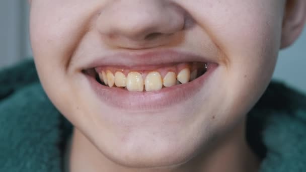 Szeroki uśmiech szczęśliwego dziecka z brudną żółtą powłoką na zębach. Zamknij się. — Wideo stockowe