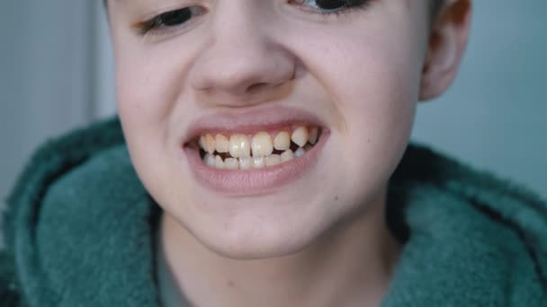 Amplia sonrisa de un niño feliz con un revestimiento amarillo sucio en sus dientes. De cerca. — Vídeos de Stock