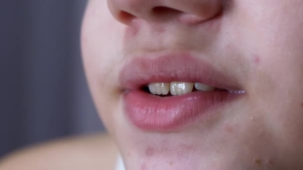 Detailní záběr na obličej, rty a ústa mluvícího teenagera s akné na kůži — Stock video