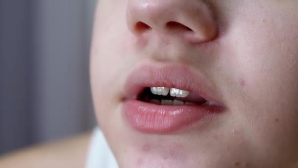 有皮肤粉刺的会说话的青少年的脸、唇和嘴的特写 — 图库视频影像