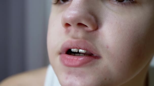 有皮肤粉刺的会说话的青少年的脸、唇和嘴的特写 — 图库视频影像
