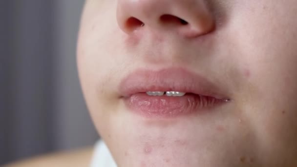 Primer plano de la cara de un niño nervioso mordiéndose los labios con los dientes. Macro — Vídeos de Stock