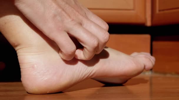 Female Hand Rubbing Reddened Skin Legs Pimple Mosquito Bite Massage — Stock video