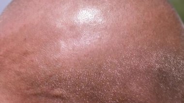 Güneş Işıkları 'ndaki Gri Saçlı Erkek Kel Kafa' nın yakın çekimi. Bronzlaşmış kafa derisi güneşte parlar. Cildinde parlaklık, parlaklık. Sıcak hava. Vücut parçası. Güneş çarpması. Sıcak çarpması. Termopleji. Doğa.