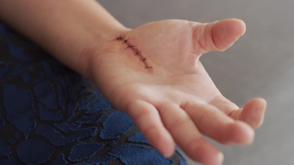 Woman Stitches Exercising Hand Carpal Tunnel Surgery — Stock Video