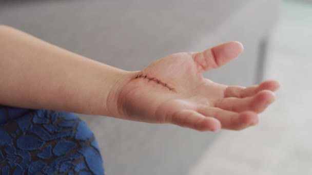 Femme Avec Des Points Suture Exerçant Main Après Chirurgie Canal — Video