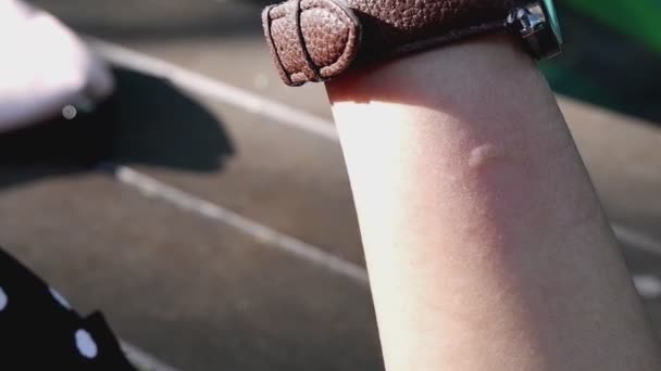女人手上的肿块被蚊子咬了 — 图库视频影像