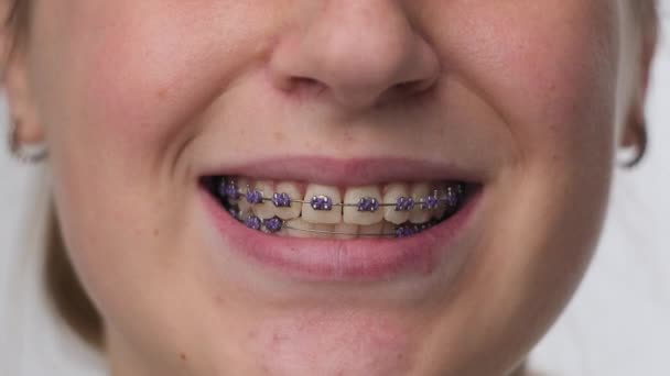 Middle shot of woman smiling in orthodontic brackets — Stockvideo