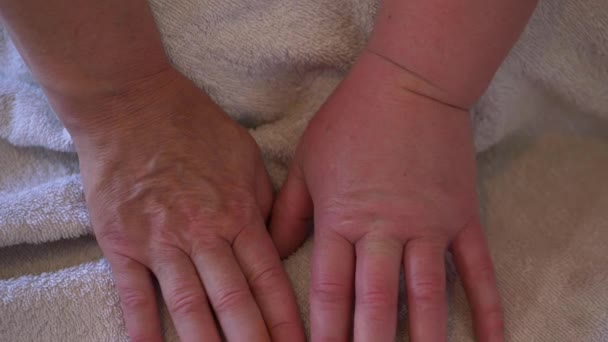 Hand gezwollen na bijensteek allergische reactie — Stockvideo