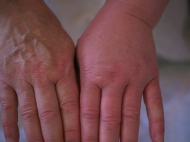 Arı sokmasından sonra el şişmiş alerjik reaksiyon. Yakın çekim seçici odaklanma.