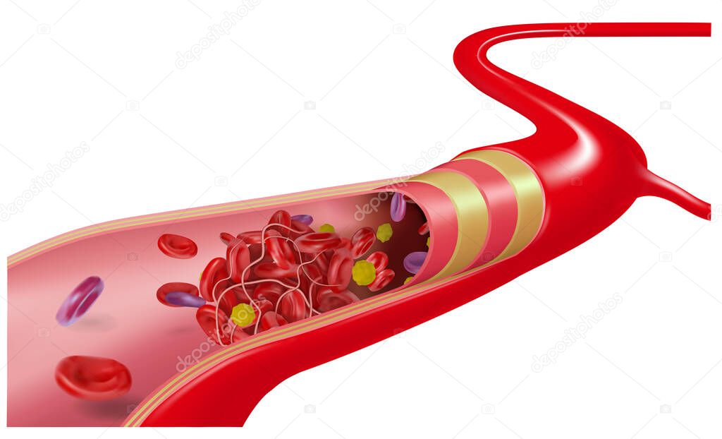 Diagram of the structure of a vein and blood with a thrombus on a white background. Vector illustration