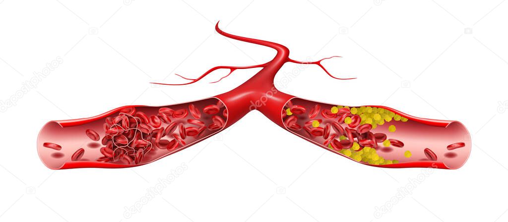 Forked vein with cholesterol and thrombus. 3d illustration