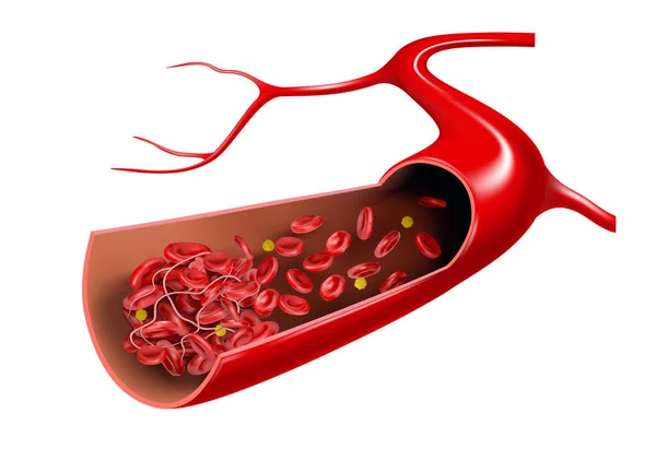 血栓和红血球在静脉中 3D说明 — 图库照片#