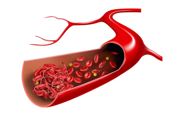 血栓和红血球在静脉中 3D矢量说明 — 图库矢量图片