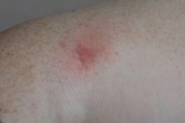 Irritation from an insect bite. Trace irritation from a bite by an unknown insect on the arm of a white European man