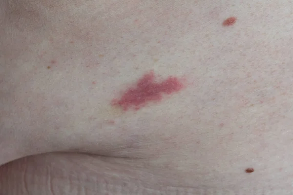Irritation from an insect bite. Trace irritation from a bite by an unknown insect on the waist of an overweight white European man