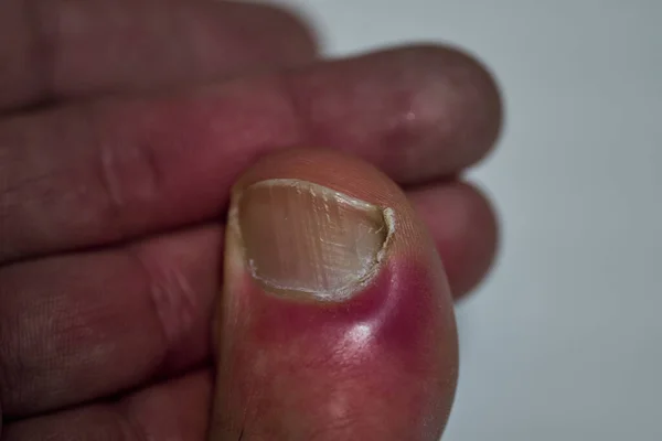 指甲旁边的感染，在病人的脚趾上 — 图库照片
