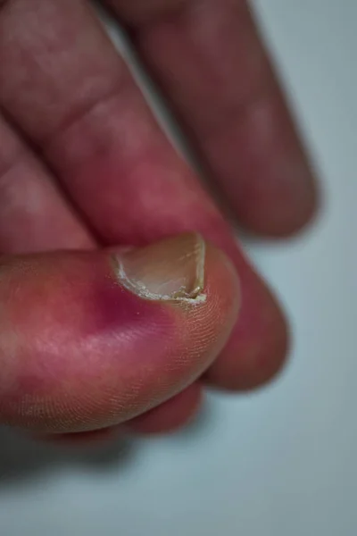 Инфекция рядом с ногтем, в пальце ноги пациента — стоковое фото