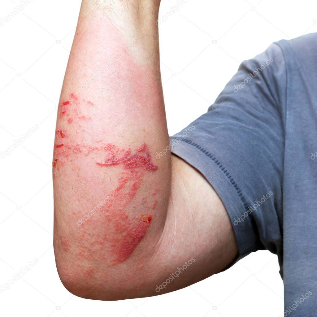 A mans arm with skin burns, swelling and injuries caused by the touch of a jellyfish while swimming in the sea isolated on the white background