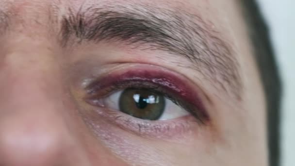 擦伤了一个男人的眼睛 有黑眼圈的年轻男性脸 在眼睑上有真正血肿的人物形象被击败了 眼睛在宏观上眨了眨眼 看着相机 面部创伤4K — 图库视频影像