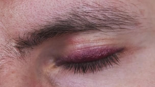 Bruise Eye Man Close Young Male Face Black Eye Portrait — Video Stock