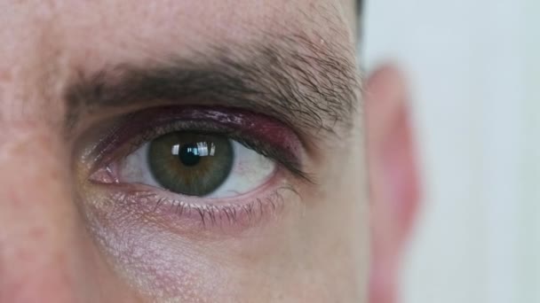 Verdadero Ojo Morado Cara Masculina Joven Moretón Párpado Hombre Cerca — Vídeos de Stock