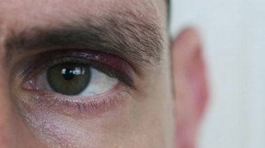 Bir adamın gözündeki çürük, yakın plan. Gözü morarmış genç bir erkek yüzü. Göz kapağında gerçek bir hematom olan dövülmüş bir adam portresi. Göz makroda yanıp sönüyor ve kameraya bakıyor. Fingal, yüz travması 4K