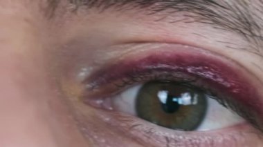 Bir adamın gözündeki çürük, yakın plan. Gözü morarmış genç bir erkek yüzü. Göz kapağında gerçek bir hematom olan dövülmüş bir adam portresi. Göz makroda yanıp sönüyor ve kameraya bakıyor. Fingal, yüz travması 4K