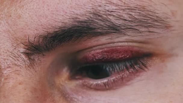 Blutergüsse Über Dem Auge Eines Mannes Aus Nächster Nähe Junger — Stockvideo