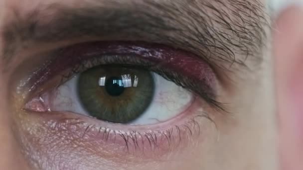 Verdadero Ojo Morado Cara Masculina Joven Moretón Párpado Hombre Cerca — Vídeo de stock