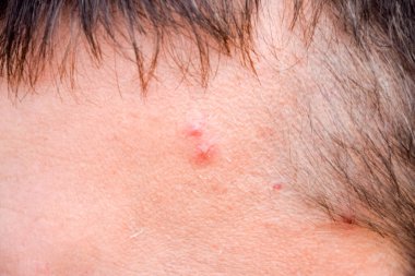 Bir adamın alnındaki sivilceler. Alnında sivilce