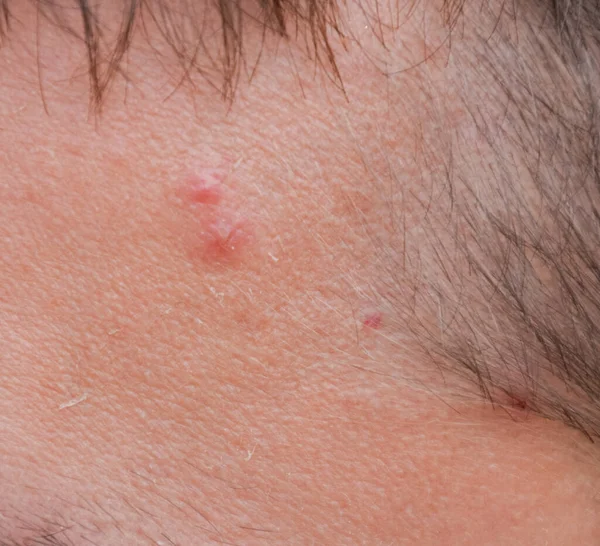 Puistjes Het Voorhoofd Van Een Man Acne Het Voorhoofd — Stockfoto