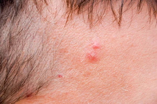 Finnar Mans Panna Acne Pannan — Stockfoto