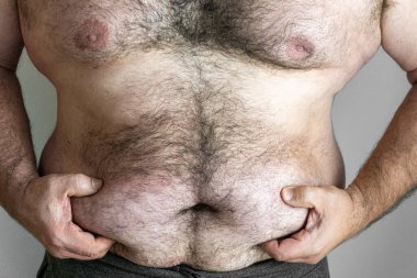 Erkek eller, göbeğin kıvrımlarını kıllı, obez bir erkek gövdesinin üzerinde tutar. Endomorf ve obezite kavramı.