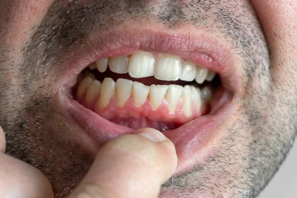 Primer Plano Los Dientes Encías Macho Sanos Con Poca Placa — Foto de Stock