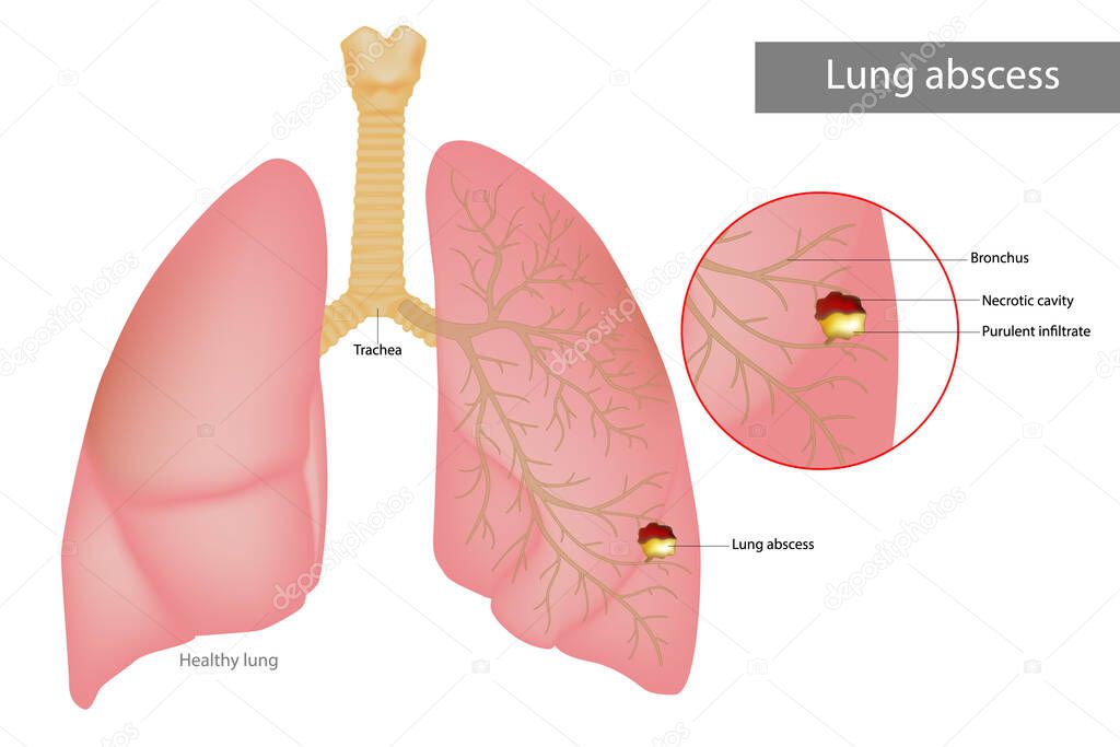 Lung abscess is a type of liquefactive necrosis of the lung tissue. Purulent infiltrate and Necrotic cavity in the lungs. Lungs disease