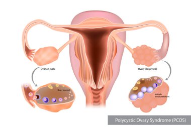 Polycystic Ovary Syndrome or PCOS. Multiple immature follicles or Ovarian cysts clipart