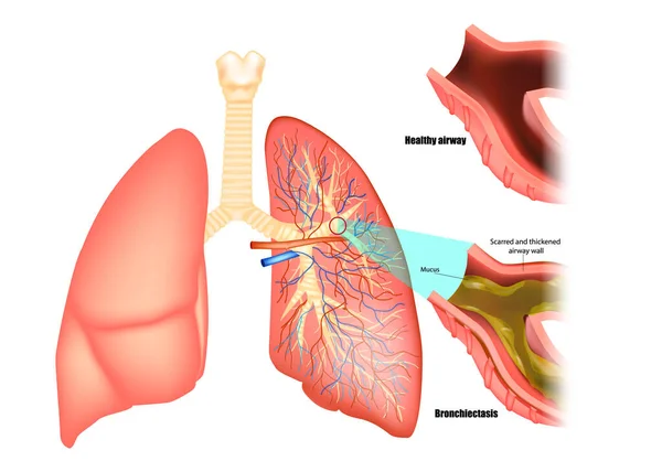 Ilustração dos pulmões afetados por bronquiectasias. Doença pulmonar obstrutiva — Vetor de Stock