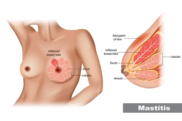 Mastitis. Az emlőmirigy keresztmetszete gyulladással. Eltömődött tejcsatorna — Stock Vector