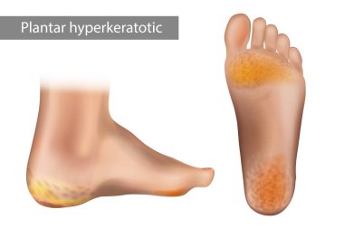 Palmoplantar hiperkeratoz. Keratoderma. Ayakta kurumuş taban ve kırık topuklu Plantar Hiperkeratozu 'nun vektör çizimi.