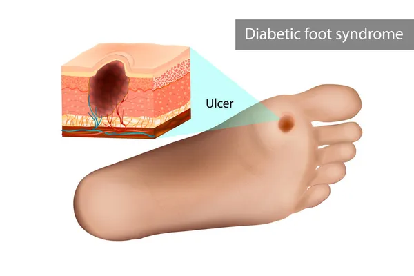 Sår efter diabetesfotsyndrom. Destruktion av djupa vävnader i foten — Stock vektor