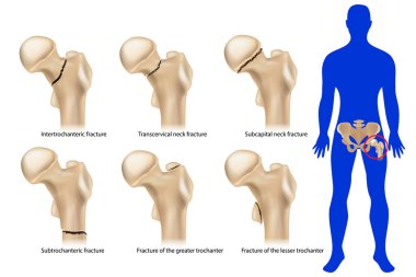 Femoral neck fracture. Types of hip fractures. Subtrochanteric, Intertrochanteric, Transcervical and Subcapital neck fracture, Fracture of the greater and lesser trochanter. clipart