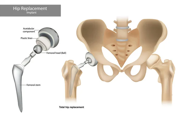 Componenti sostitutivi totali dell'anca. Impianto anca. — Vettoriale Stock
