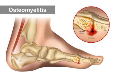 Kemik iltihabı bir kemik enfeksiyonudur. Diyagram, insan ayak kemiğinin osteomyelit olduğunu gösteriyor..