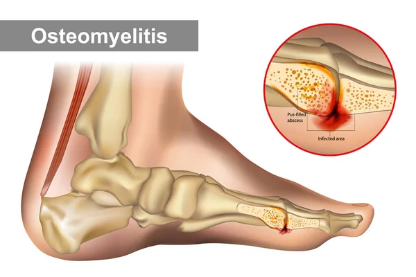 La osteomielitis es una infección ósea. Diagrama muestra osteomielitis de un hueso del pie humano. — Archivo Imágenes Vectoriales