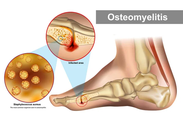 Osteomyelit är en beninfektion. Stafylokocker aureus vanligaste organismen ses vid osteomyelit — Stock vektor